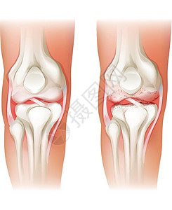 人膝关节炎图片