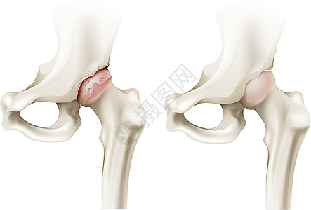 髋关节炎图片
