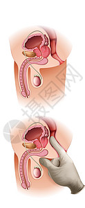 前列腺癌手术遗传学问题白色冷冻变压科学疾病身体检查骨头图片