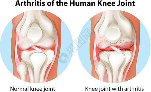 人类膝关节的关节炎加入图片