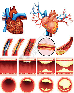 心脏胆固醇图片