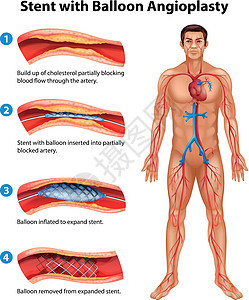 支架血管成形术药品心脏病外科手术导管硬化牌匾插图医生动脉图片