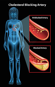 动脉硬化动脉心脏病积累硬化血管致命组织攻击疾病导管图片