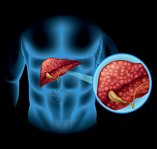 人体硬化图夹子器官生物学艺术癌症插图医疗卡通片x光图表图片