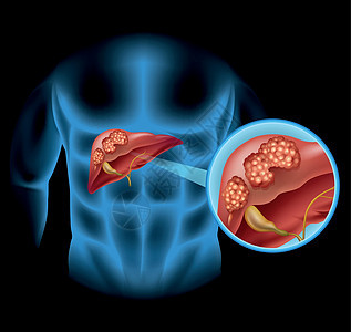 肝癌详细图解蓝色科学疾病x光绘画癌症医疗男人解剖学图表图片