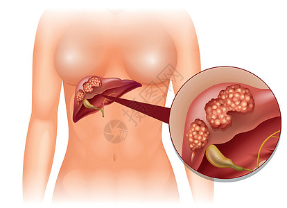 肝癌详细图解女士科学绘画艺术症状图表医疗疾病生物夹子图片