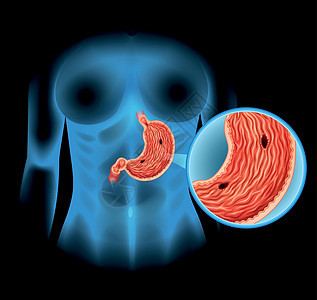 人体胃溃疡图x光疾病生物学图表教育艺术绘画生物夹子癌症背景图片