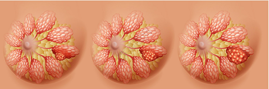 乳腺癌三期图图片