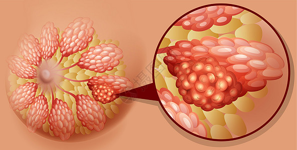 详细的乳腺癌图生物学女士夹子癌症人体药品艺术医疗教育生物图片