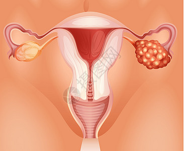 woma卵巢癌科学治疗部位疼痛疾病生物学图表医疗药品身体图片