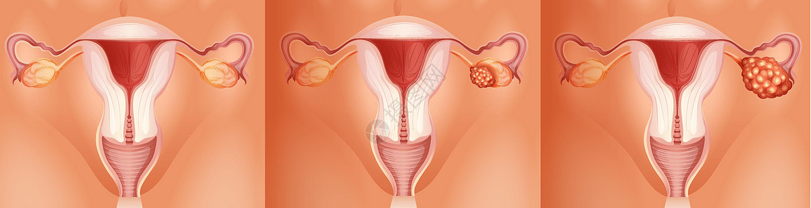 卵巢癌的三个阶段图片