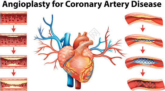 冠状动脉疾病血管成形术示意图图片