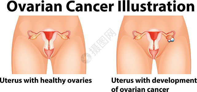 显示人类卵巢癌的图表图片