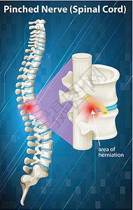 脊髓神经受压示意图图片