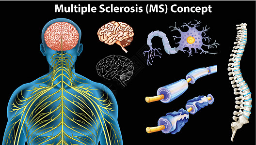 显示多发性硬化症概念的图表卫生器官解剖学血管科学静脉绘画保健神经系统核子图片