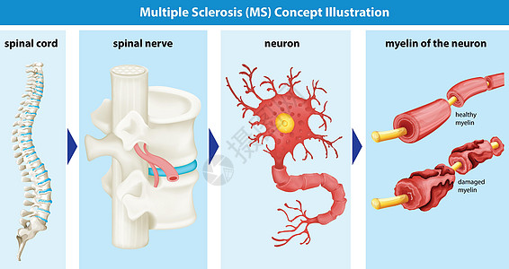 显示多发性硬化症概念的图表神经解剖学健康生物疾病艺术夹子器官硬化癌症图片