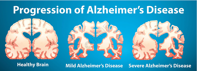蓝色背景下阿尔茨海默病的进展图片