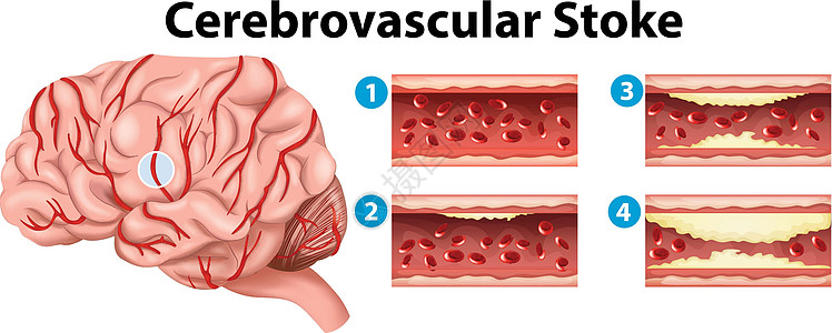 显示脑血管中风阶段的图表图片