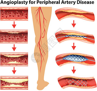 外周动脉疾病血管成形术示意图图片