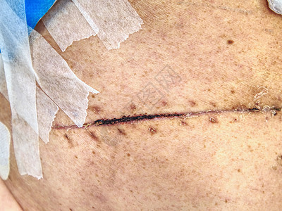 腹部和身体侧的一连串新伤疤图片