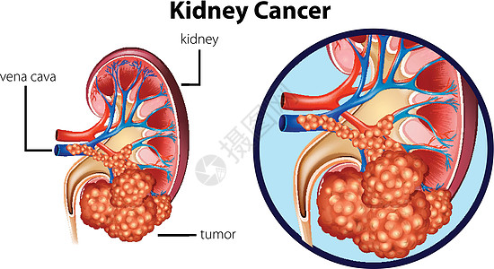 显示肾癌的图表器官生物夹子医生剪裁插图健康人体科学小路图片