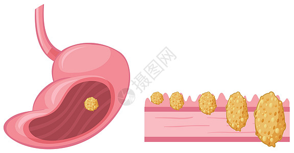 人类胃癌医疗生物学艺术小路健康x光疾病器官绘画剪裁图片