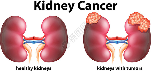 显示人类肾癌的图表小路解剖学医疗技术艺术疾病医生生物插图夹子图片