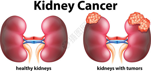 显示人类肾癌的图表小路解剖学医疗技术艺术疾病医生生物插图夹子图片