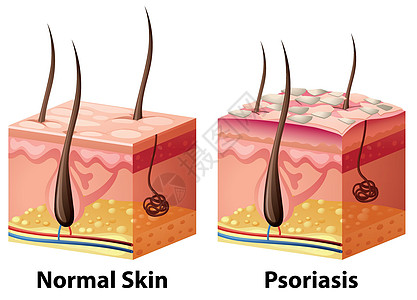 正常和牛皮癣的人体皮肤图图片