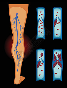 人体中的血块图片
