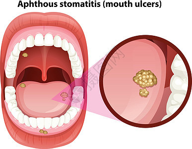 人类口腔溃疡解剖图片