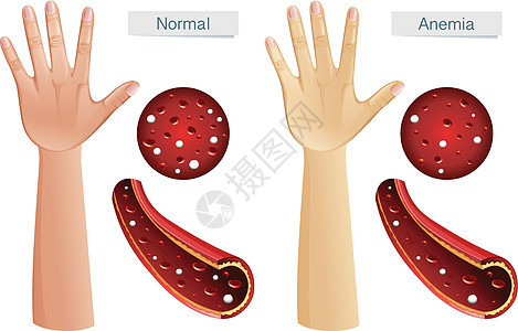 Anemi 的人体解剖学载体图片
