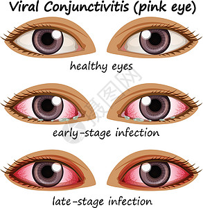 人眼病毒性结膜炎图片