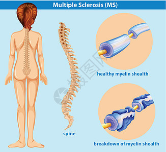Sclerosi 的教育海报图片