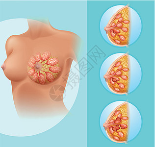 女性乳腺癌生物疾病人体绘画女士科学插图癌症器官生物学图片