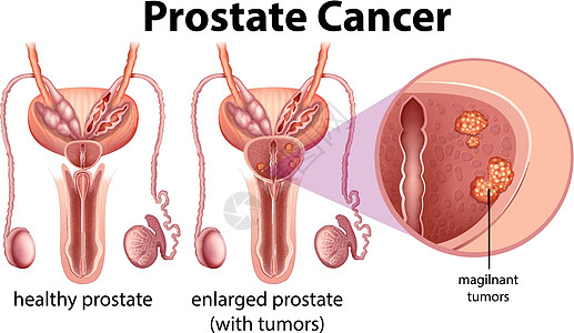 在白色背景上的前列腺癌夹子肿瘤帮助疾病魔术师药品插图前列腺男人男性图片