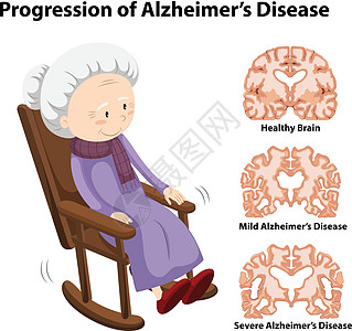阿尔茨海默病的进展年龄解剖学艺术插图记忆夹子大脑祖母绘画女性图片