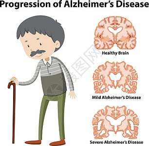 阿尔茨海默病的进展科学老年保健医院状况治疗医生插图绘画夹子图片