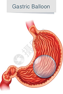 解剖医学载体胃球图片
