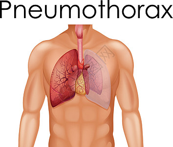 气胸的人体解剖学图片
