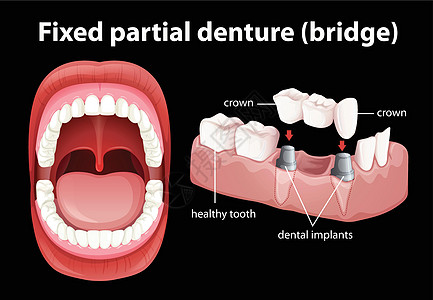 固定局部义齿的医学载体图片