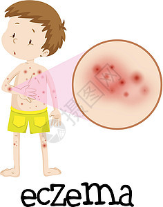 湿疹的人类医学教育背景图片