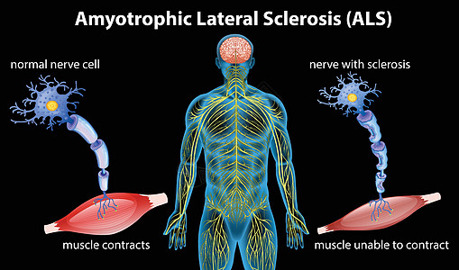 肌萎缩侧索硬化的解剖图片