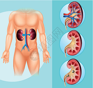 人与肾结石图片
