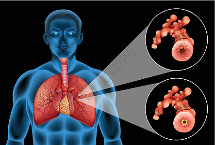 显示人类肺部和疾病的图表图片