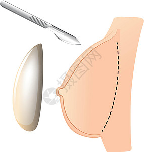 植入物和手术刀隆胸图片