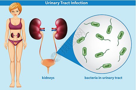 尿路感染的人体解剖学图片