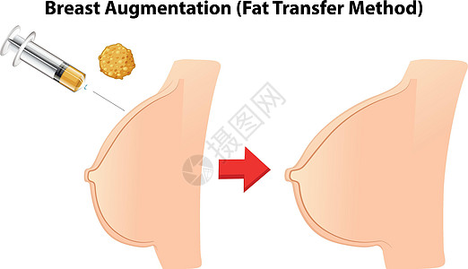 隆胸脂肪移植法医疗绘画艺术切口方法手术女士乳腺身体塑料图片
