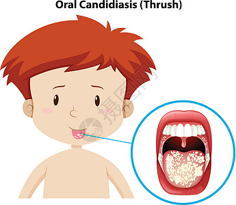 患有口腔念珠菌的小男孩图片
