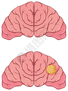 患有癌症的人脑图片